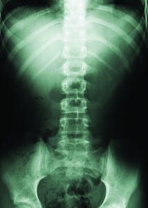 Spinal compression fractures often ignored, misunderstood