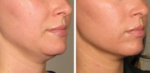 Before and after photos from a lower face Ultherapy treatment.