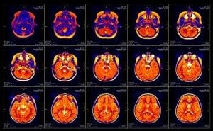 Brain MRI slide of a girl. Actual patient and clinic names have been omitted.