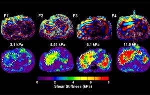 Magnetic resonance elastography (MRE) images like these will be used to track the various stages of liver disease development among HIV-positive drug users.*