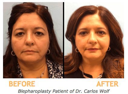 Blepharoplasty Patient of Dr. Carlos Wolf-min