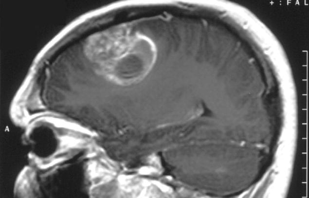 Glioblastoma_-_MR_sagittal_with_contrast-e1500585107902