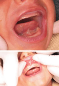 Infants with tongue-tie can have problems with breastfeeding and experience reflux and colic.