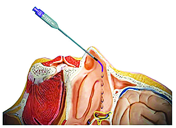 Chronic headache relief can be achieved with breakthrough procedure, ‘SPG Block’